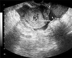 Image-2-Moderate-Free-Fluid-In-The-Cul-De-Sac-Of-Douglas – Zuckerem @  Northwell