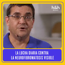 La neurofibromatosis no solo deja marcas visibles, también deja huellas  emocionales difíciles de sanar. Descubre cómo la doctora aborda este caso  con humanidad y ciencia. 🌿✨ ¿Qué estará sucediendo?  https://www.facebook.com/watch/?v=747228271172025
