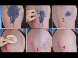 As your skin ages, your tattoo ages with it. Temp Remove Tattoo Naturally Remove Tattoo Lasertattooremoval Laserremoval Tattoomachine Ta Black Ink Tattoos Tattoo Removal Results Tattoo Removal Cream