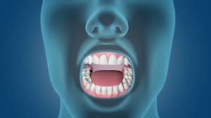 Most oral cancers are squamous cell carcinomas. What Is Mouth Cancer How Can It Be Healed With The Help Of Ayurveda