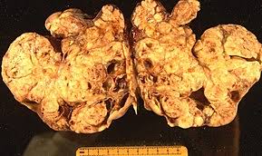 I have had 2 ablations about 16 years ago and was put on steriods 8 years ago because of suspected adrenal tumour, which has subsequently, recently, been shown not to exist. Ovarian Cancer Wikipedia