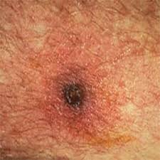 Maybe you would like to learn more about one of these? Typhus