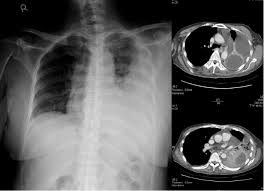 Image result for Lung Abscess