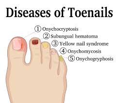 Bacterial infection under the nail also causes dark or green spots on toenails. Black Spot Under The Toenail Causes Home Remedies Best Treatment