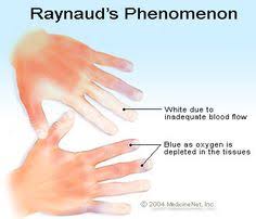 Pronunciation of raynauds with 1 audio pronunciations 0 rating rating ratings record the pronunciation of this word in your own voice and play it to listen to how you have pronounced it. 8 Raynaud S Ideas Raynauds Raynaud S Disease Raynaud S Phenomenon