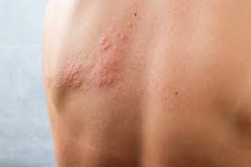 Image result for contact dermatitis