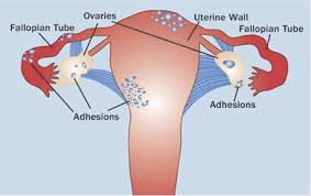 Endometriosis is a disease in which tissue that normally grows inside the uterus grows outside it. Endometriosis The Resilient Sisterhood Project