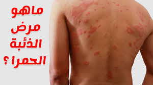 Vi sono altre patologie associate; Ù…Ø±Ø¶ Ø§Ù„Ø°Ø¦Ø¨Ø© Ø§Ù„Ø­Ù…Ø±Ø§Ø¡ Ø¨Ø§Ù„ØµÙˆØ± ÙƒÙŠÙ ØªØªØ®Ù„Øµ Ù…Ù† Ø§Ù„Ø°Ø¦Ø¨Ø© Ø§Ù„Ø­Ù…Ø±Ø§Ø¡ Ø­Ø±ÙƒØ§Øª