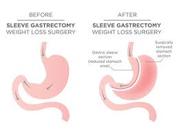 sleeve gastrectomy weight loss surgery