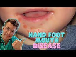Image result for Hand foot and mouth disease HFMD roof of mouth