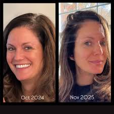 Christmas 2017. I was just telling my husband this morning that I literally  thought that was the real shape of my face. I didn't realize that I was so  badly inflamed. I