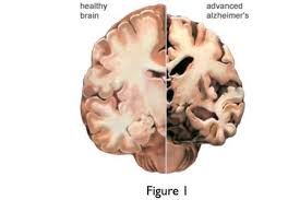 Maybe you would like to learn more about one of these? Early Dementia And Functional Brain Networks Libc Blog