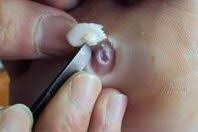 Corn Removal Surgery Costs Before And After Procedure Foot Toe Corn Removal Surgery Beautyzion Corn On Toe Toe Corn Removal Corn Removal