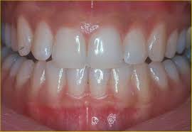 Typically caused by a buildup of bacteria in your mouth, gum disease isn't serious at first, but w. Healthy Gums Michael E Krone D D S Family Dentistry
