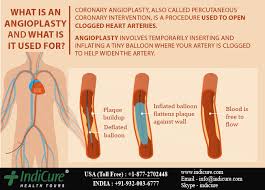 Pin On Heart Surgery