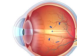 Image result for Floaters