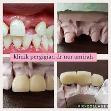 Check spelling or type a new query. Bridge Jambatan Gigi Klinik Pergigian Dr Nur Amirah Facebook