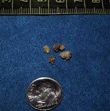 Kidney Stones Durward Black Md