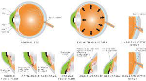 Glaucoma tends to run in families. What Is Glaucoma Eyegas Consultants