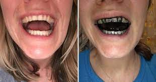 Rasa nyeri akan anda rasakan terus menerus sampai ditangani. Hentikan Ubat Gigi Arang Segera Ini Sebab Kukuh Kenapa Pakar Gigi Larang Penggunaanya