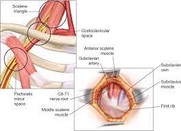 Thoracic Outlet Procedures Transaxillary Approach Thoracic Key