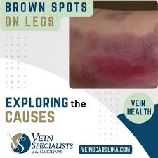 Image result for liver spots on legs