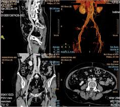 Deep Vein Thrombosis Due To May Thurner Syndrome A Case Report Bmc Cardiovascular Disorders Full Text