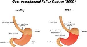 What acid reflux relief strategies are effective? Gerd Heartburn Ayurvedic Treatment Tips Remedies