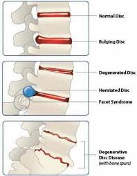 Disk Pathology They Stopped Spelling It Disc Many Years Ago Nurse Teaching Nursing Study Medical Education