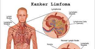 Kanker jenis ini bermula dari sel limfosit (salah satu jenis sel darah putih) yang berkembang secara abnormal. Mengenal Kanker Ganas Limfoma Warta Pilihan