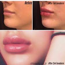 Top Right Before Filler Top Left 1ml Juvederm Ultra Bottom 2ml Juvederm Ultra Perfect Pillowy Lips Lip Fillers Dermal Fillers Lips Juvederm Lips