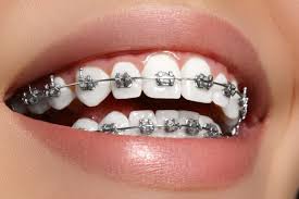 This wire is changed periodically throughout treatment as teeth move to their new positions. Best New Tools For Clean Braces Klement Family Dental