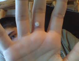 Maybe you would like to learn more about one of these? Fucking Warts Man Gaf Md Advice Needed Also Gross Pic Of Said Wart Neogaf