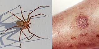 Image result for Tarantula Bite