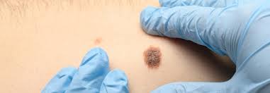 A sensation of flashes or specks of dust in your vision (floaters) a growing dark spot on the iris. Melanoma Vitalskin Dermatology