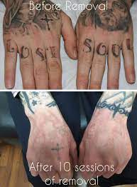 In general, the tattoo removal procedure doesn't hurt as much as the original inking, but don't forget that the. Laser Tattoo Removal Everything You Need To Know Authoritytattoo