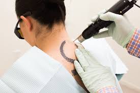 You need to make tattoo removal cream at home by mixing sand powder, grinding stone, and aloe vera gel. 11 Things No One Tells You About Tattoo Removal Glamour