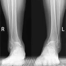 Image result for Ankle XRay