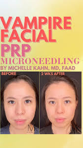 🩸 Vampire Diaries Part 2: The Vampire Facial