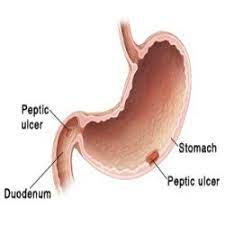 6 Effective Herbal Remedies For Peptic Ulcers Peptic Ulcer Ulcers Herbalism