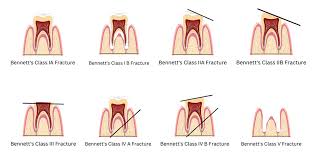 Image result for Tooth Fracture