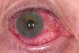 Image result for Acute Red Eye