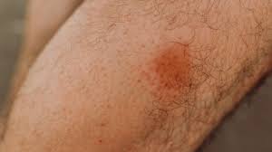 Image result for Fly Bite