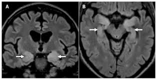 A herpes simplex virus type 2 (hsv 2) etiology was sought in 93 consecutive cases of herpes simplex encephalitis (hse) in immunocompetent post neonate magnetic resonance imaging (mri) showed bilateral temporal. Diagnosing Autoimmune Limbic Encephalitis Cmaj