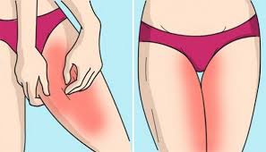 Get Rid Of The Irritated Skin Between Your Legs Quickly And Efficiently Using This Simple And Natural Method Inner Thigh Rash Inner Thigh Leg Rash
