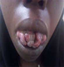 Image result for papillomavirus tongue)