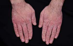 5 Ways To Treat Your Chapped Hands Nebraska Medicine Omaha Ne