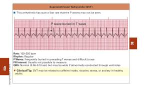 Ecg Notes 44 728 Jpg 1 213 728 Pixels Ekg Interpretation Nursing Students Pr Interval