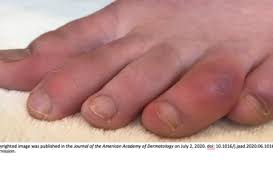Maybe you would like to learn more about one of these? Covid Toes Managing This Unusual Covid 19 Manifestation Infectious Disease Special Edition