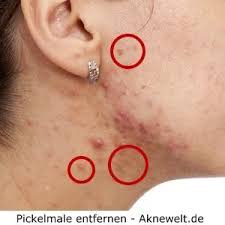 Was kann man tun, um die dunklen narben loszuwerden? Pickelmale Entfernen Was Hilft Gegen Flecken Nach Pickel Akne Pickel Mitesser Pickel Mitesser Anti Pickel